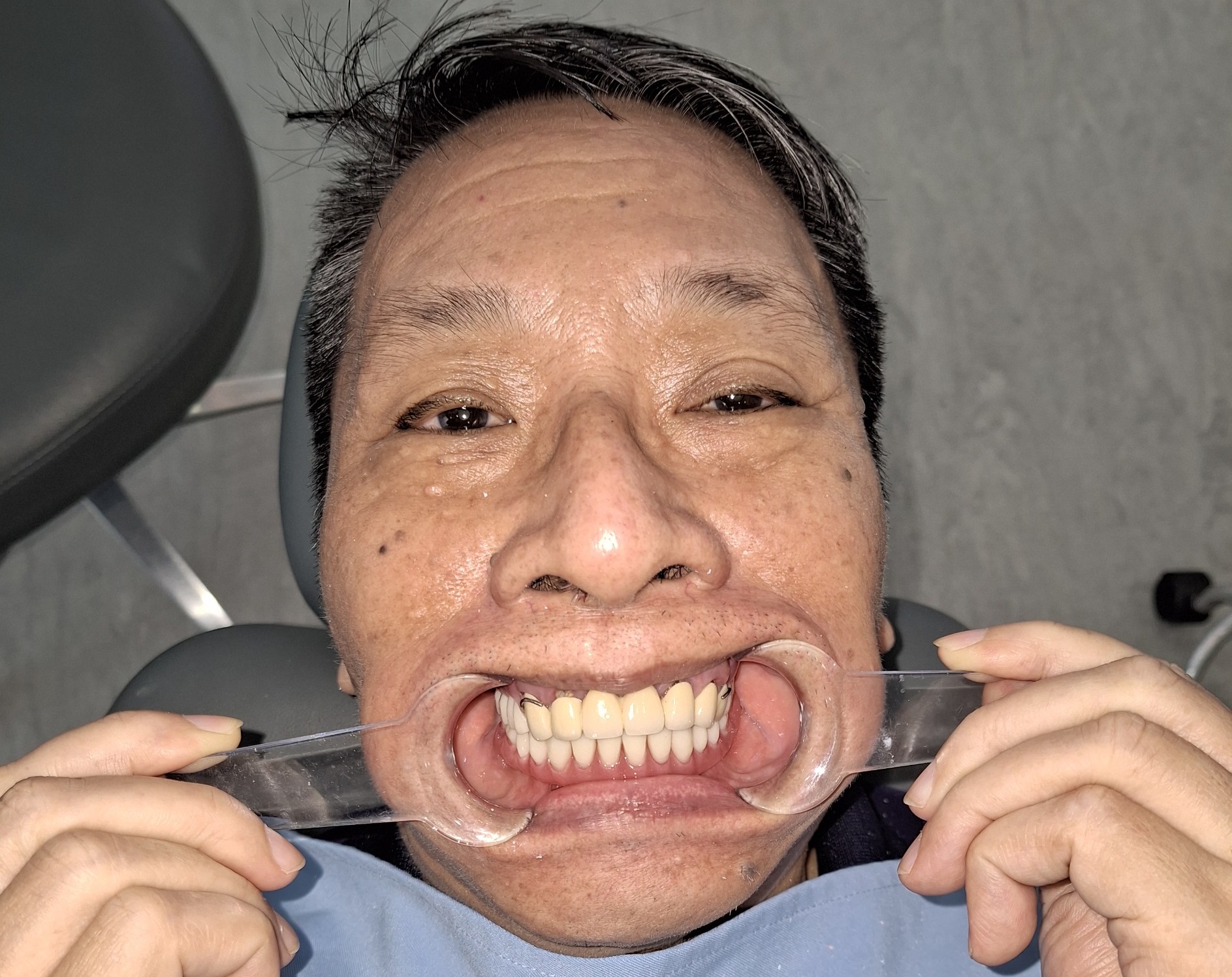 Before treatment