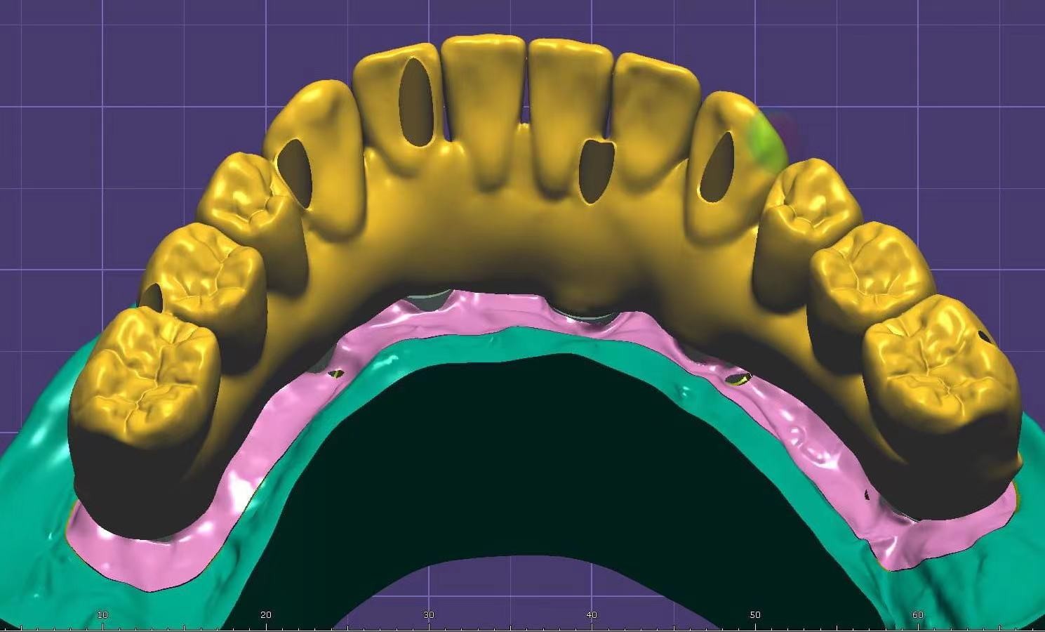 CAD/CAM crown restoration