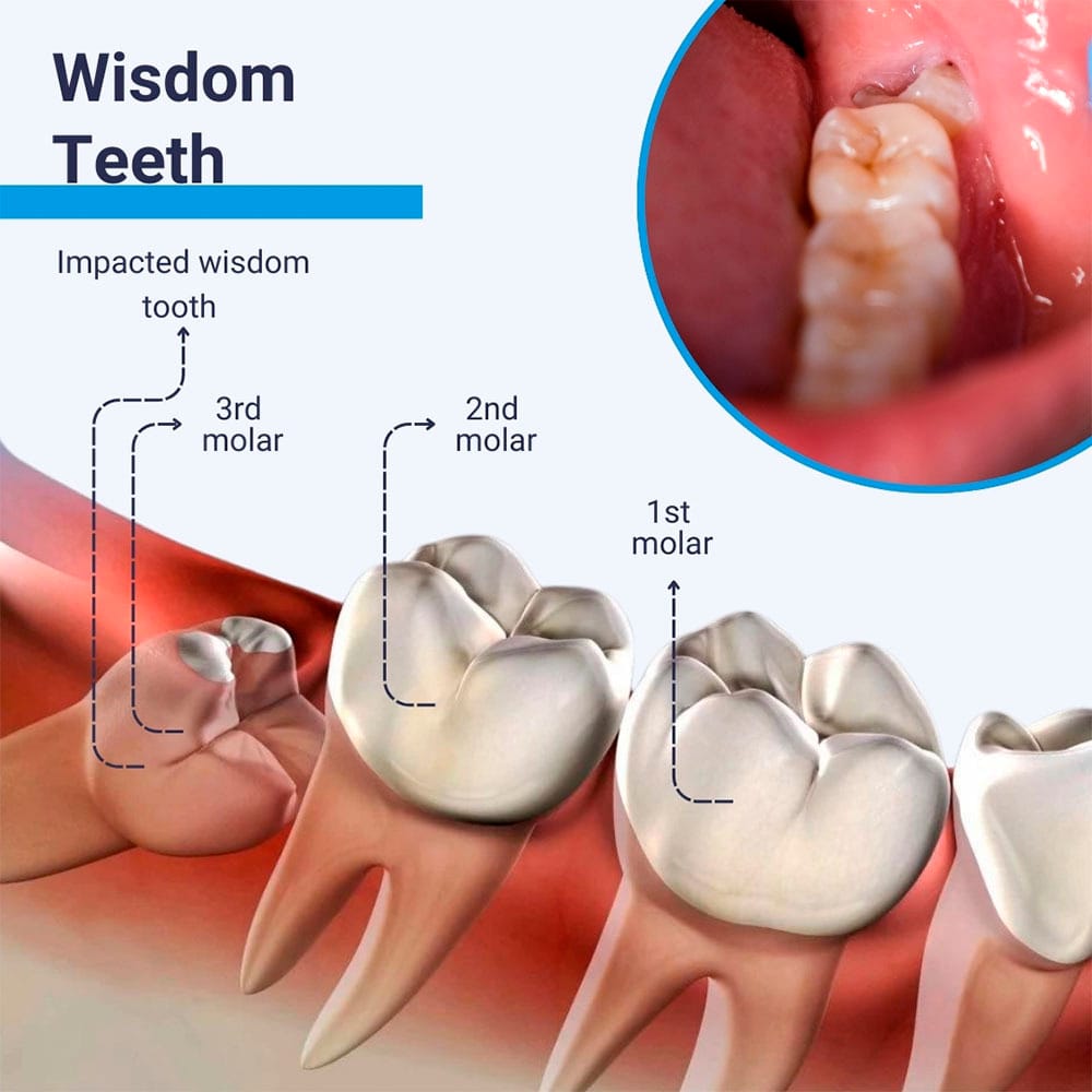 Wisdom teeth diagram